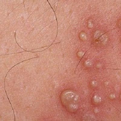 Ways of infection with genital herpes - symptoms, diagnosis, treatment and prevention Herpes simplex on the genitals