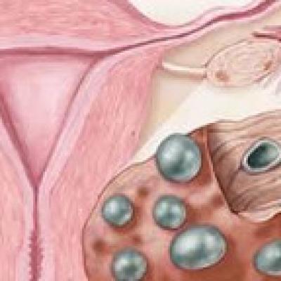 Polycystic ovary syndrome, what is it?